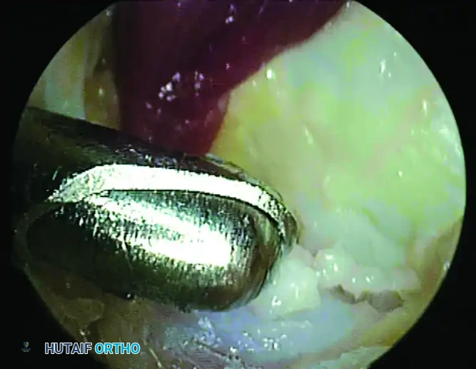 POSTERIOR DÉBRIDEMENT FOR ANKLE IMPINGEMENT Surgical Diagram