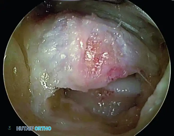 POSTERIOR DÉBRIDEMENT FOR ANKLE IMPINGEMENT Surgical Diagram