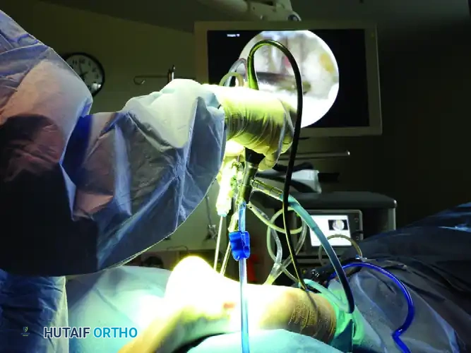 POSTERIOR DÉBRIDEMENT FOR ANKLE IMPINGEMENT Surgical Diagram