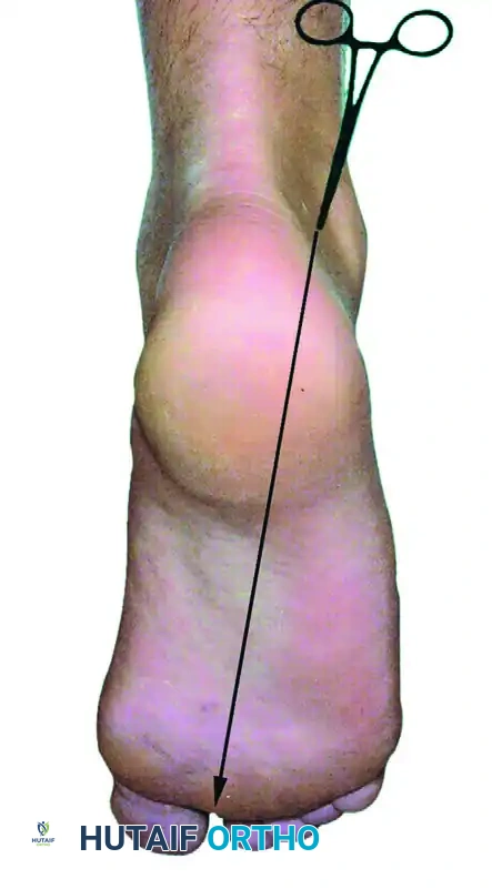 POSTERIOR DÉBRIDEMENT FOR ANKLE IMPINGEMENT Surgical Diagram