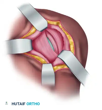 Exposure of underlying muscles