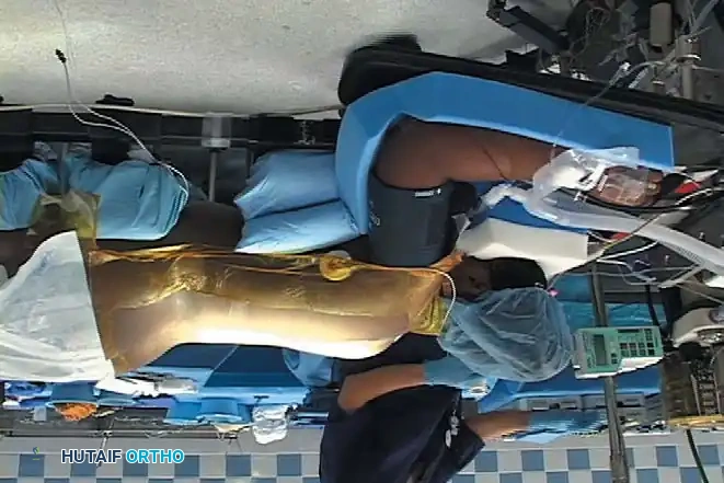 Posterior Surgeries for Idiopathic Scoliosis: A Masterclass in Surgical Technique