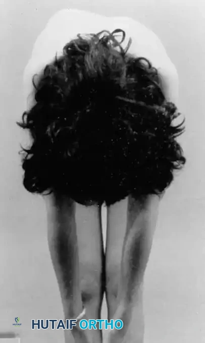 Fig. 38-75 Posterior rib prominence in adolescent patient with idiopathic scoliosis.