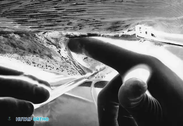 Elevator is used to strip periosteum and muscle around inferior edge of rib.