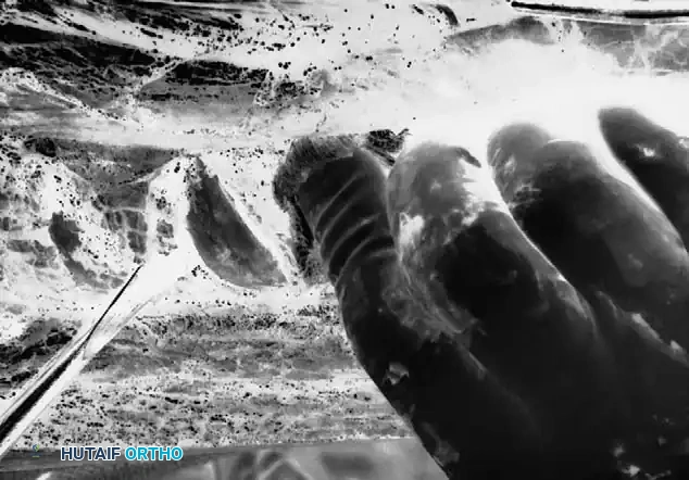 Thoracolumbar fascia is elevated off paravertebral muscle fascia.