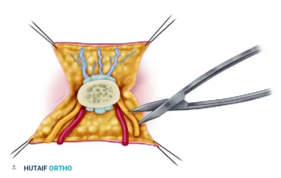 الدليل الشامل لجراحة إعادة زراعة الأطراف والأصابع المبتورة