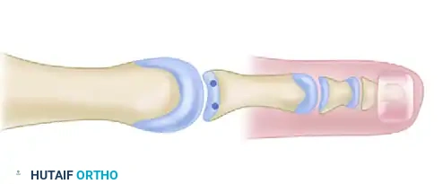 PRIMARY PLANTAR PLATE REPAIR THROUGH A DORSAL APPROACH Surgical Diagram