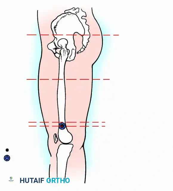Radical amputation or disarticulation