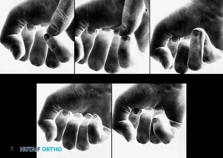 Mastering the Principles of Treatment for Hand Fractures and Dislocations