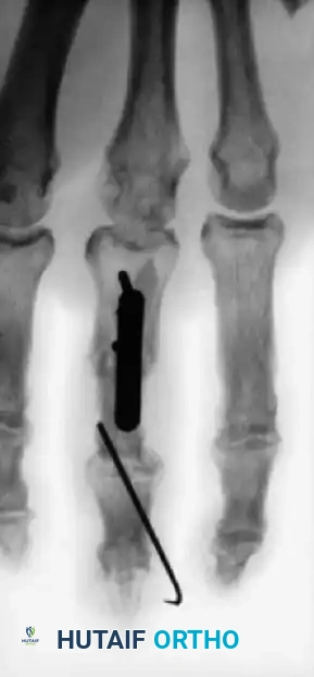 Fig. 64-4 A and B, Open fractures of right hand with loss of distal end of middle phalanx and painful small ﬁ nger partial amputation. C and D, Proximal phalanx of painful and stiff small ﬁ nger was used as structural graft to restore articular column of middle ﬁ nger.