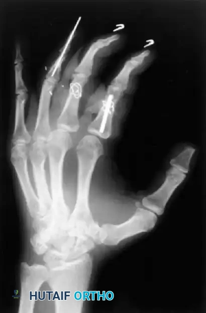 Fig. 64-5 Various techniques employed to manage middle phalangeal fractures in multidigit replantation. Combination intramedullary Kirschner wire rod and wiring in index ﬁ nger and intraosseous wiring alone in middle ﬁ nger with good rotational control.