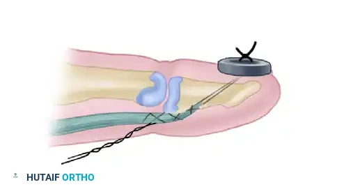 Flexor Digitorum Profundus Advancement: Surgical Technique