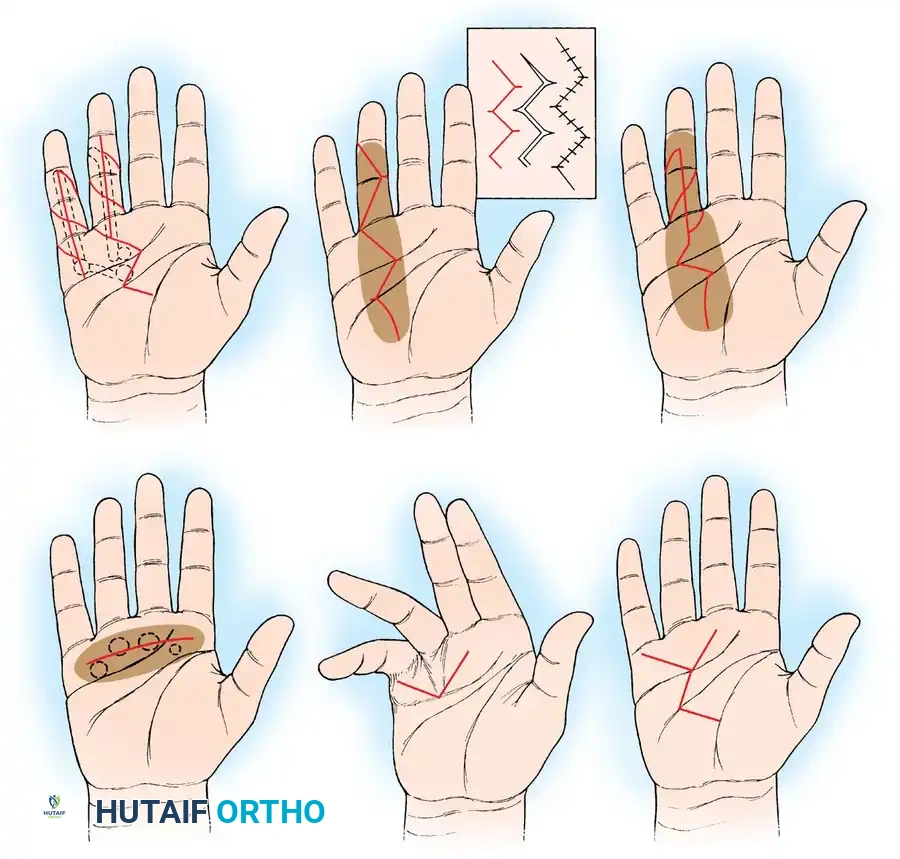 Surgical Incision Options