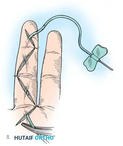 Surgical Dissection Step 2