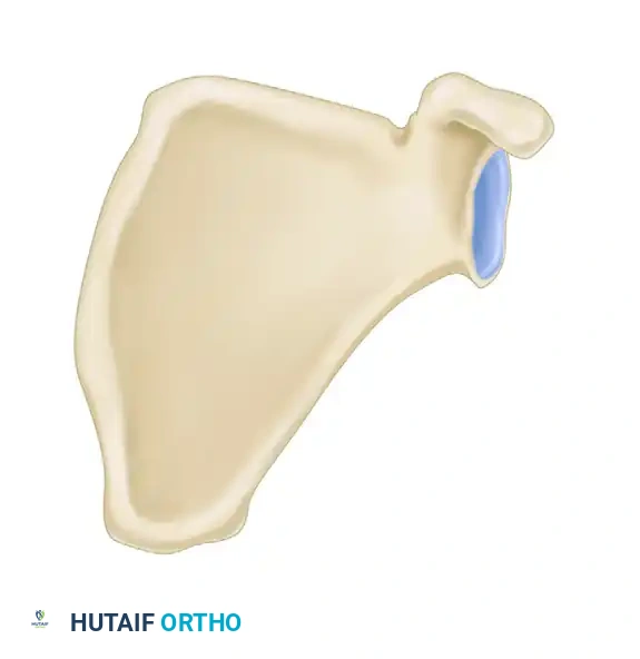 Illustration of proximal humeral fractures - Dr. Mohammed Hutaif