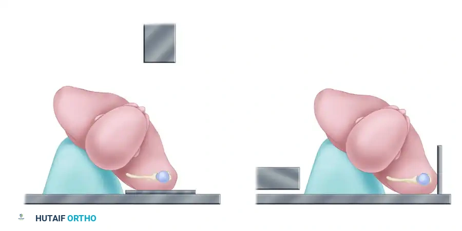 صورة أشعة سينية توضح الرؤية الأمامية الخلفية لمفصل الكتف