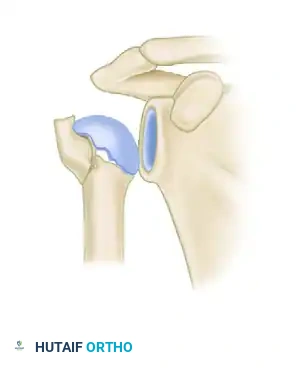 معيار هيرتيل الثاني امتداد عظمي قصير يشير إلى خطر على التروية الدموية