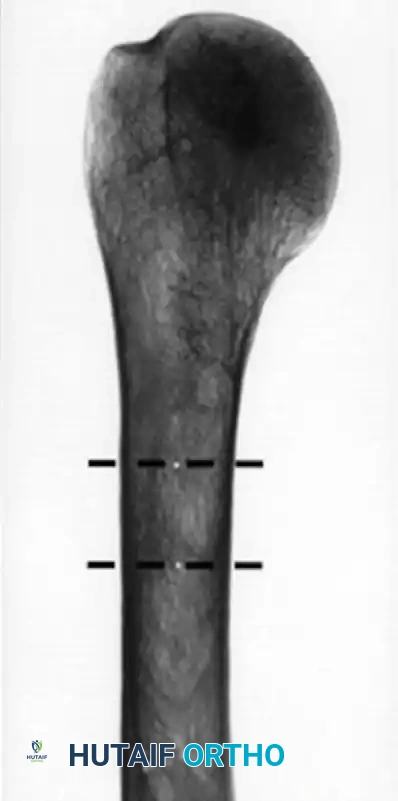 صورة أشعة لمريض يتمتع بكثافة عظمية عالية وقشرة سميكة مناسبة للتثبيت الجراحي