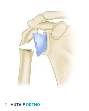 معيار هيرتيل الأول امتداد عظمي جيد يشير إلى تشخيص إيجابي للتروية
