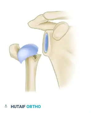 معيار هيرتيل الرابع إزاحة كبيرة في المفصلة الداخلية تنذر بخطر نخر العظام