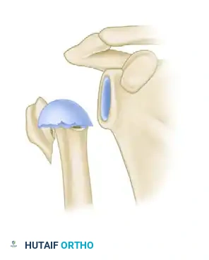 معيار هيرتيل الثالث مفصلة داخلية سليمة تحافظ على الأوعية الدموية