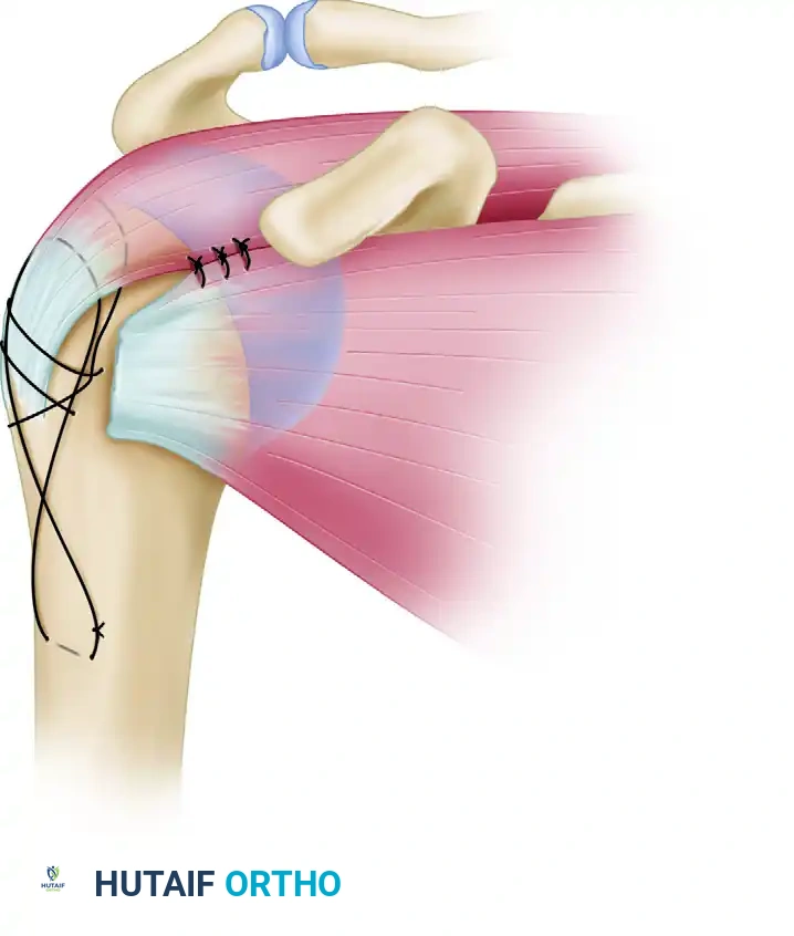 استخدام الخيوط الطبية المتينة لتثبيت العظام والأوتار في مفصل الكتف