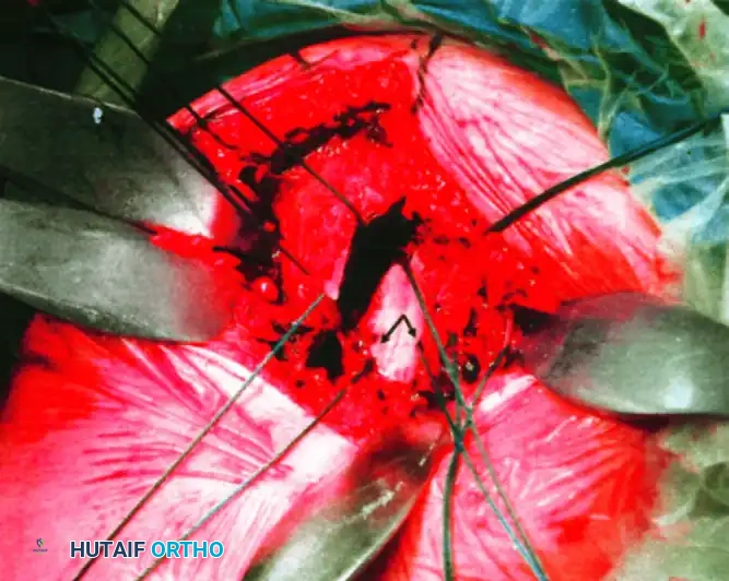 صورة أشعة أثناء العملية توضح إدخال الدبابيس المعدنية لتثبيت رأس العضد