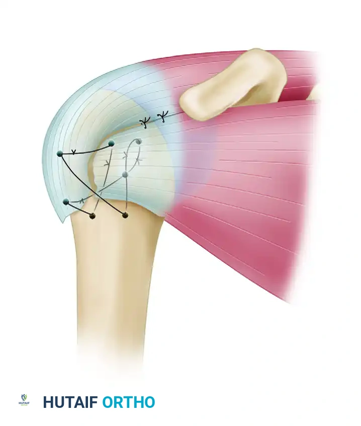 صورة أشعة جانبية تؤكد التثبيت السليم للدبابيس في عدة اتجاهات