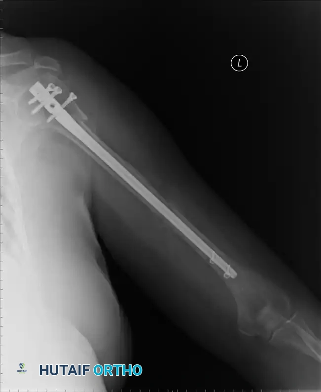 إدخال السلك الدليلي وتوسيع القناة النخاعية تمهيداً لوضع المسمار