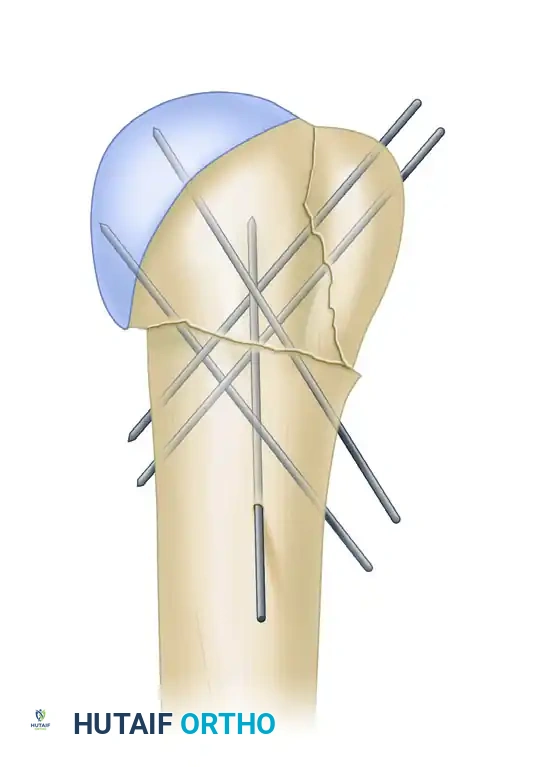 صورة أشعة نهائية توضح التثبيت الناجح والمستقر باستخدام المسمار النخاعي