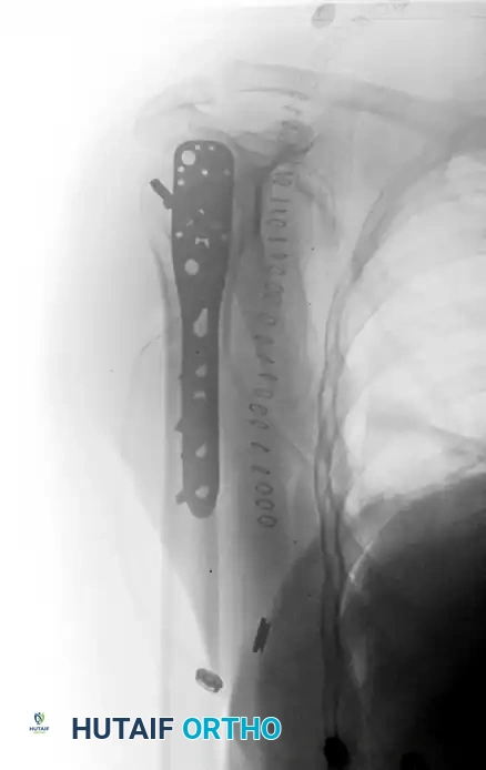 رسم تشريحي يوضح تداخل الأجزاء العظمية بعد التثبيت الجراحي