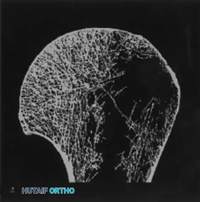 صورة إشعاعية توضح التثبيت الداخلي للكتف