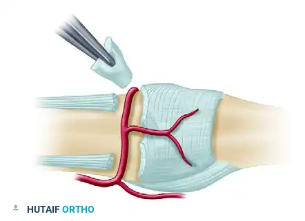 PROXIMAL INTERPHALANGEAL JOINT CAPSULOTOMY Surgical Diagram
