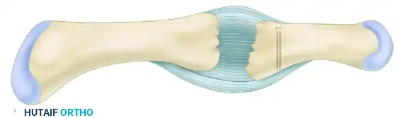 Proximal Interphalangeal Joint Volar Plate Interposition Arthroplasty: A Comprehensive Surgical Guide