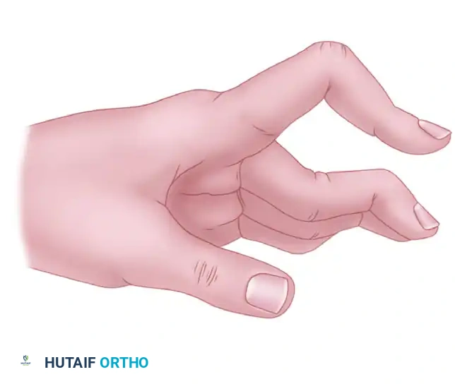 PROXIMAL INTERPHALANGEAL JOINT ARTHROPLASTY THROUGH A DORSAL APPROACH Surgical Diagram