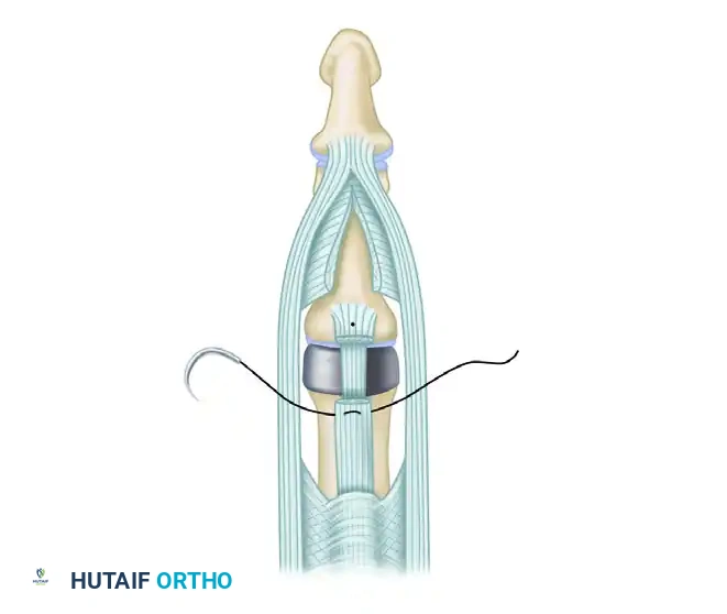 PROXIMAL INTERPHALANGEAL JOINT ARTHROPLASTY THROUGH A DORSAL APPROACH Surgical Diagram