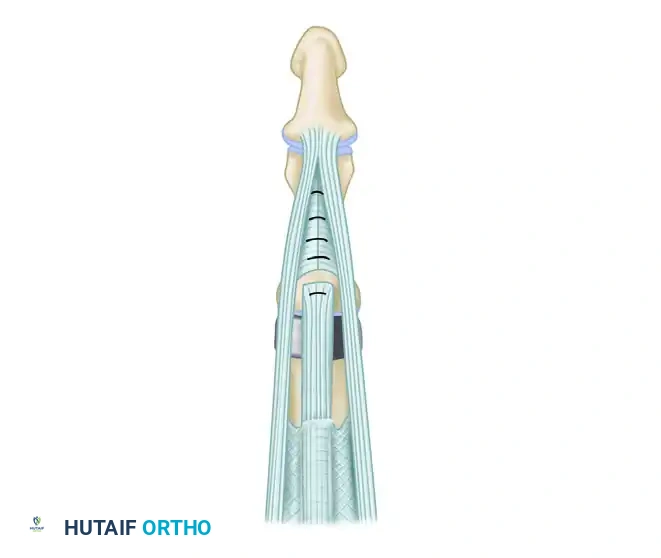PROXIMAL INTERPHALANGEAL JOINT ARTHROPLASTY THROUGH A DORSAL APPROACH Surgical Diagram