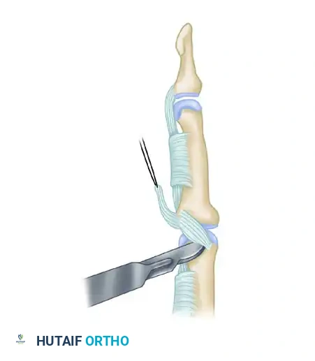 PROXIMAL INTERPHALANGEAL JOINT ARTHROPLASTY THROUGH A DORSAL APPROACH Surgical Diagram