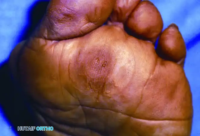 Lesion appeared to be plantar keratosis until pared down to reveal wart