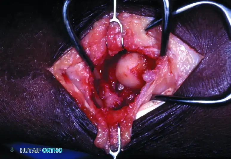 الشكل النهائي للرسغ بعد إزالة الصف الداني من العظام