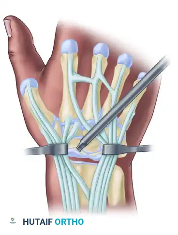 Proximal Row Carpectomy: Comprehensive Surgical Technique and Biomechanics