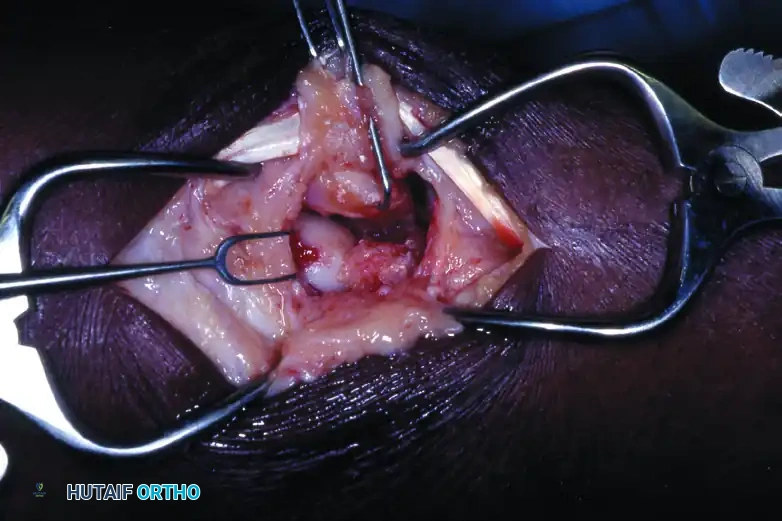 تفاصيل إزالة العظم الزورقي والهلالي خلال الجراحة