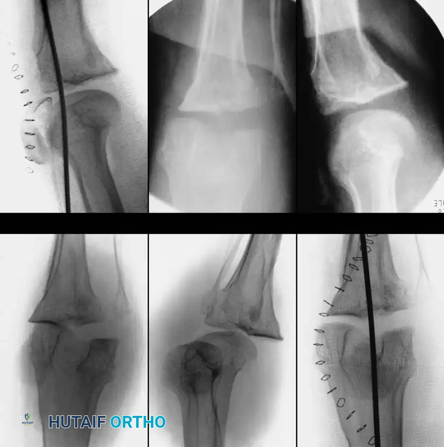 PROXIMAL TIBIOFIBULAR JOINT Surgical Diagram