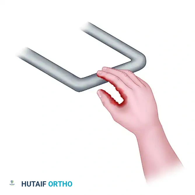 Management of Radiation, Electrical, and Chemical Burns of the Hand