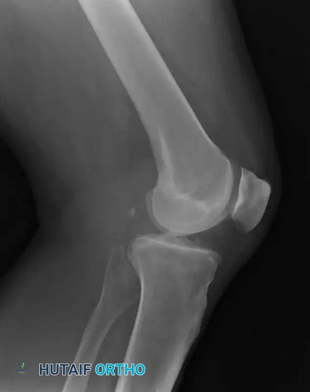 Radiographic Evaluation and Surgical Planning for Patellofemoral Disorders