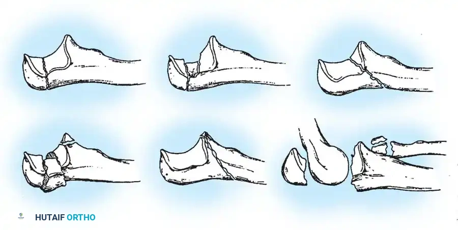 Mastering the Operative Management of Olecranon Fractures