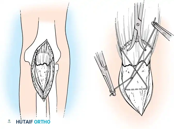 Fig. 54-54 Internal ﬁ xation of olecranon with tension band wire loop.