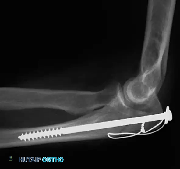Fig. 54-55 Olecranon fracture repaired with long 6.5-mm AO cancellous screw and ﬁ gure-of-eight tension band wire loop.