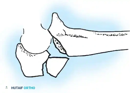 RADIUS AND ULNA Surgical Diagram