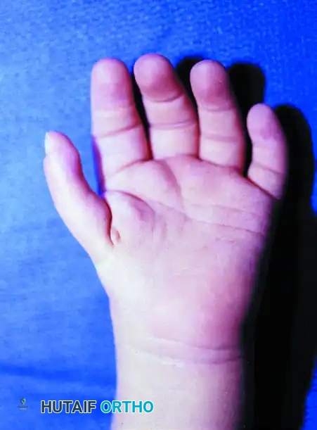 Clinical Appearance of Clasped Thumb